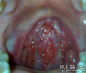 咽炎吃瓜之后严重,警惕饮食不当引发的健康危机